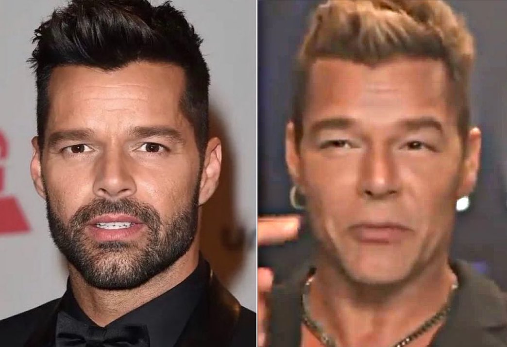 Ricky Martin se defiende: no fue cirugía estética, sino alergia