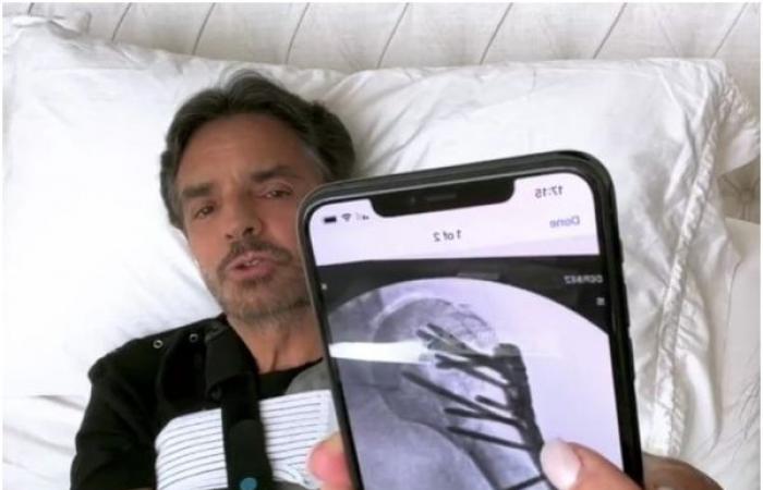 Eugenio Derbez reaparece tras cirugía y da detalles de su accidente