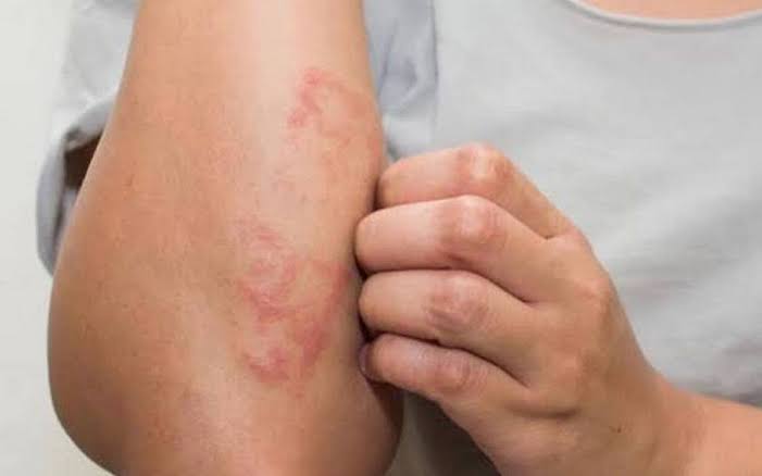 Secretaría de Salud emite alerta por contagios de lepra en México, conoce sus síntomas