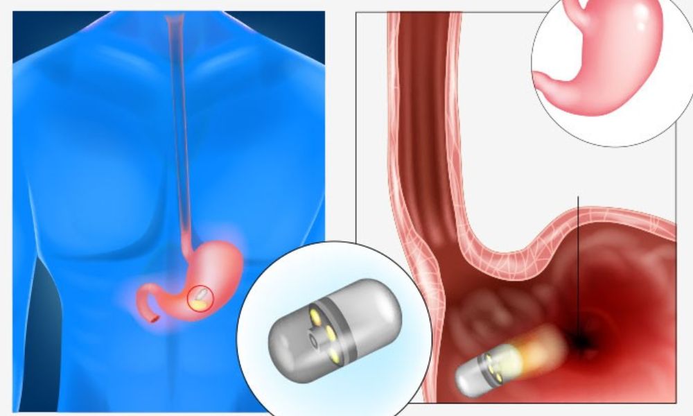 Endoscopia en cápsula