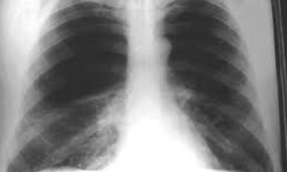 Enfisema pulmonar, efecto en el tórax