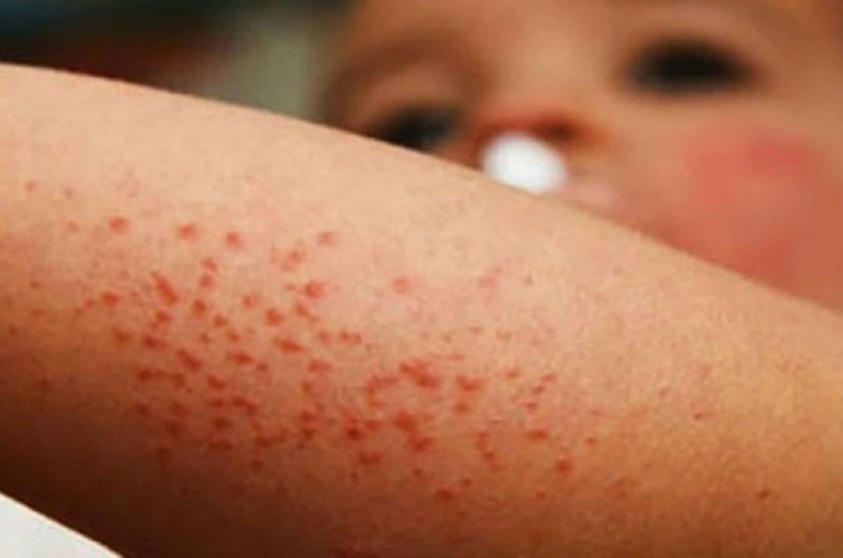 Alerta por posible brote de sarampión en México: Síntomas y cómo se contagia