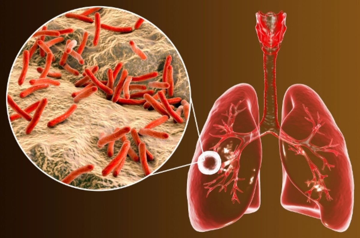 Tuberculosis: Síntomas, tratamiento y prevención