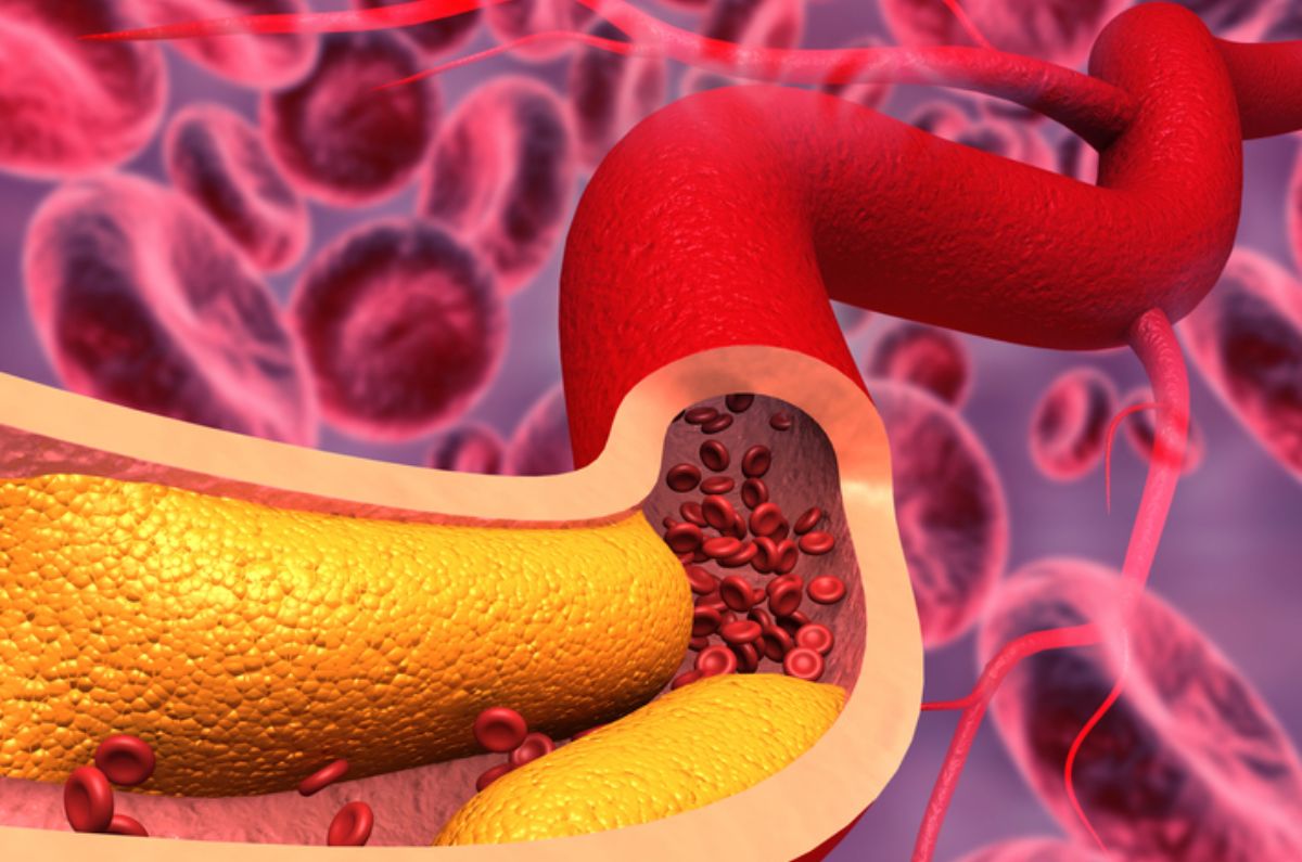 Colesterol alto: Los peligros de la hipercolesterolemia