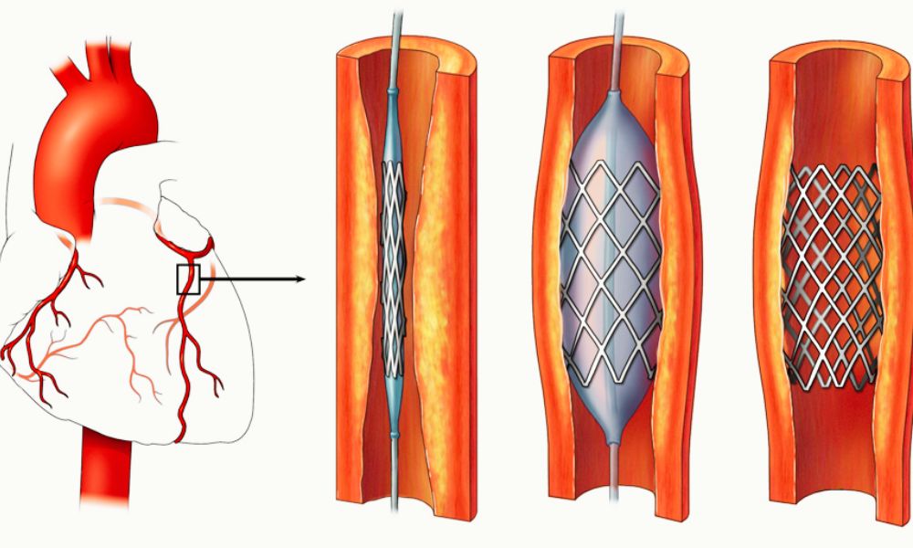 Endoprótesis (stents)