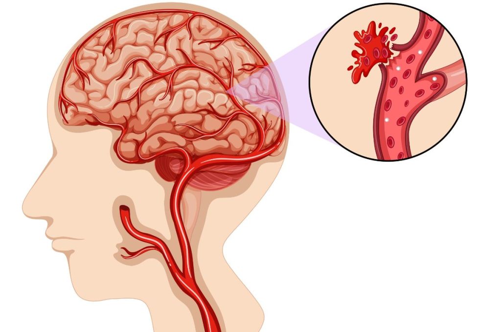 Accidente cerebrovascular