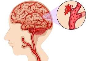Estrategias para lidiar con un accidente cerebrovascular