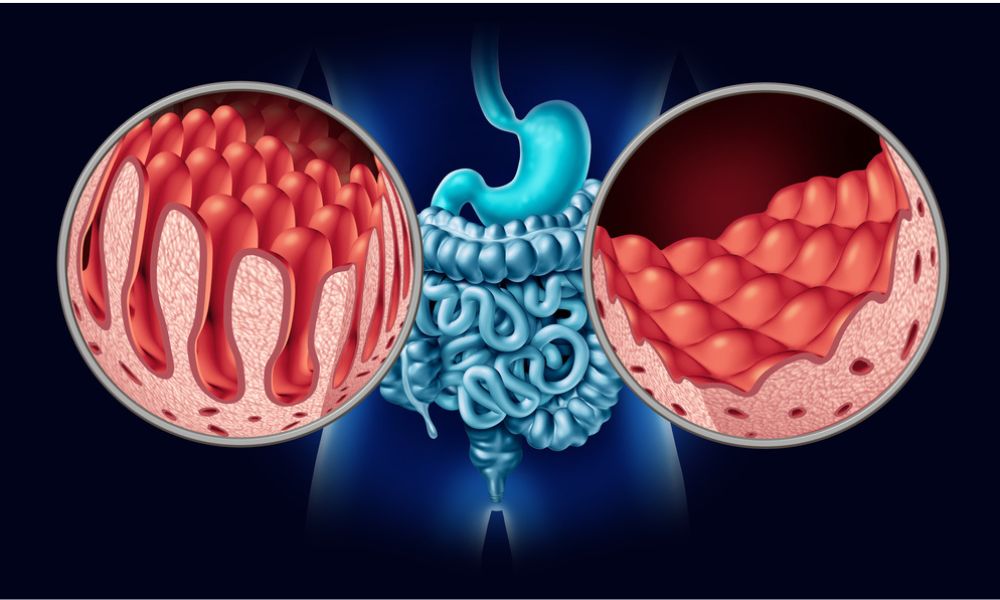 Afección del intestino delgado