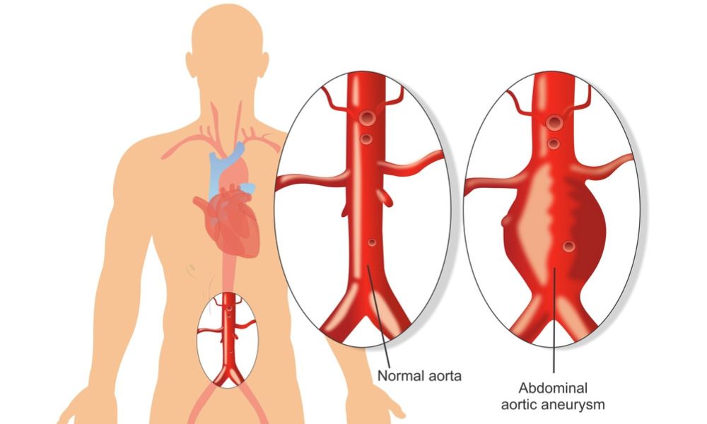 Aneurisma de aorta