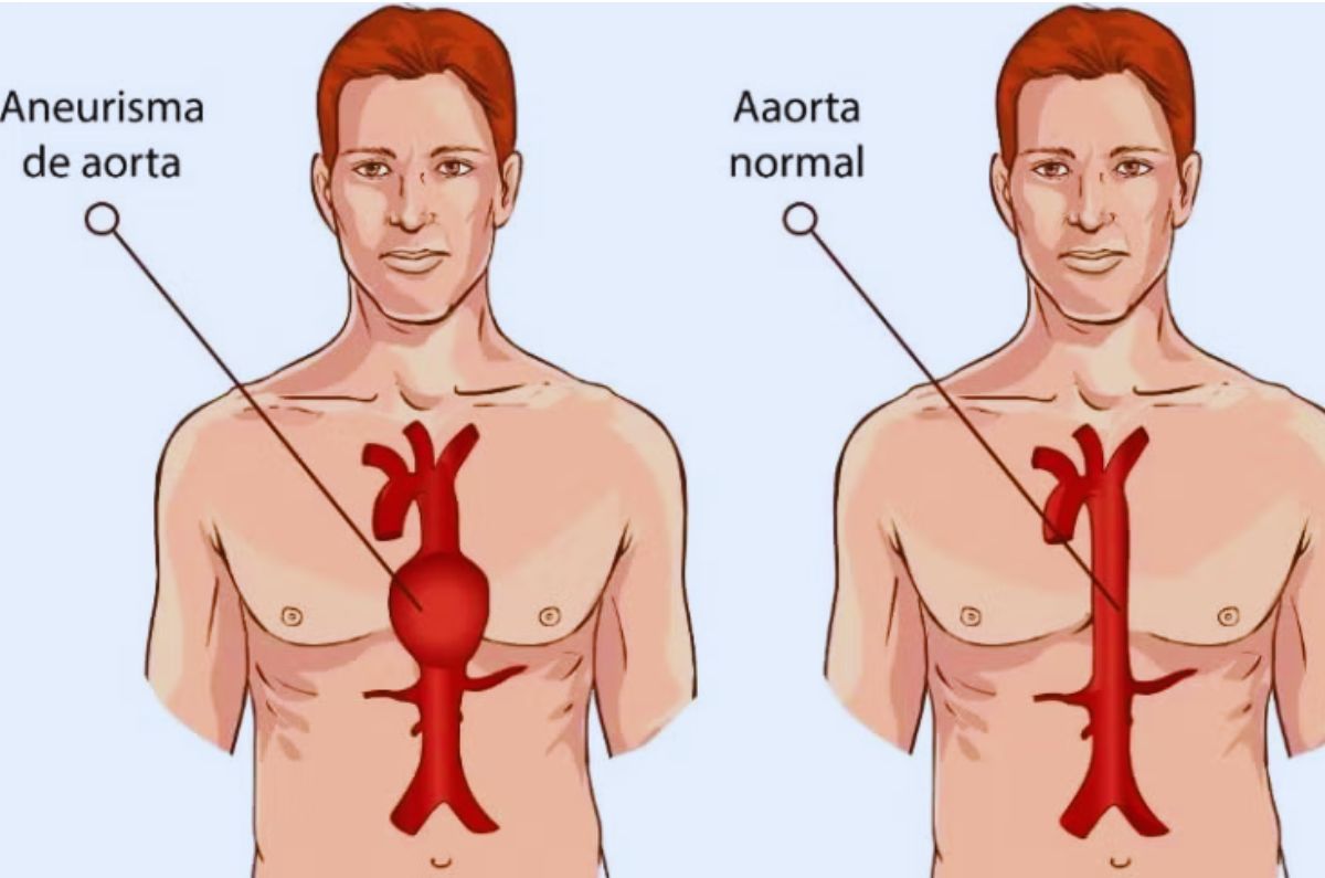 Aneurisma de aorta: Un enemigo silencioso para el corazón