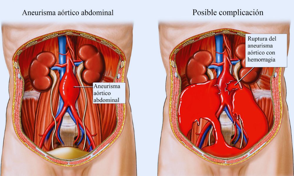 Aneurismas aórticos abdominales