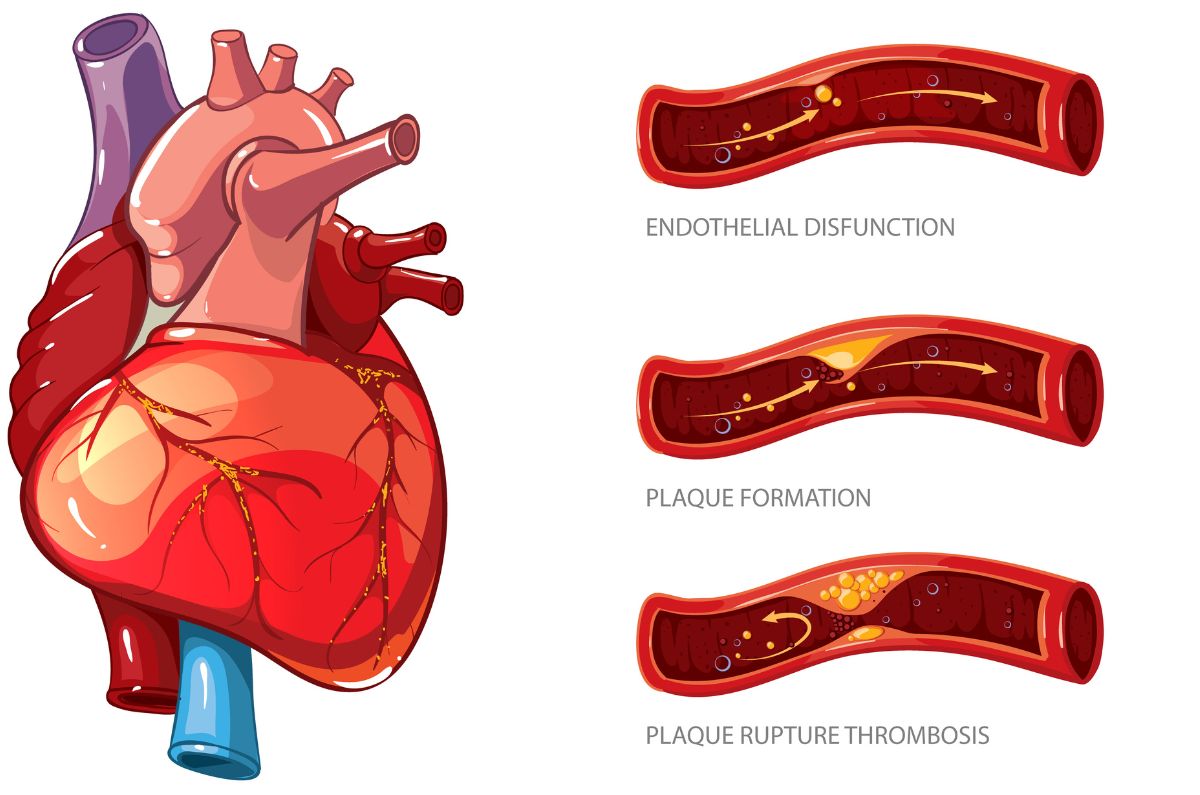 La cardiopatía isquémica y cómo podemos combatirla