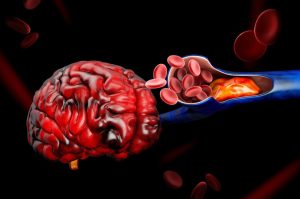 Conoce qué es y porqué se ocasiona un derrame cerebral