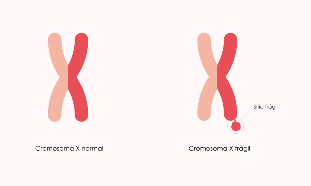 Genética del síndrome del cromosoma X frágil