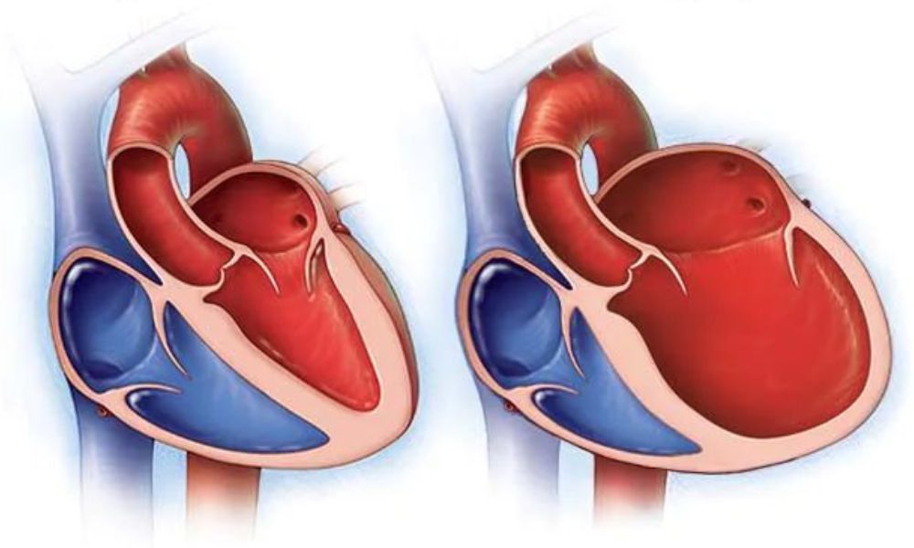 Miocardiopatía dilatada
