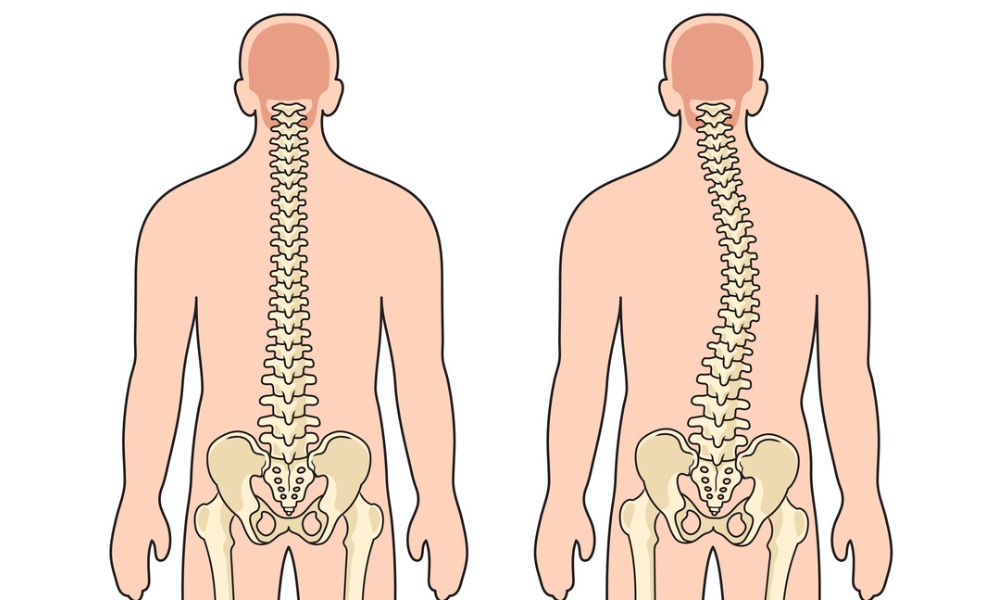 Síndrome de Marfan complicaciones