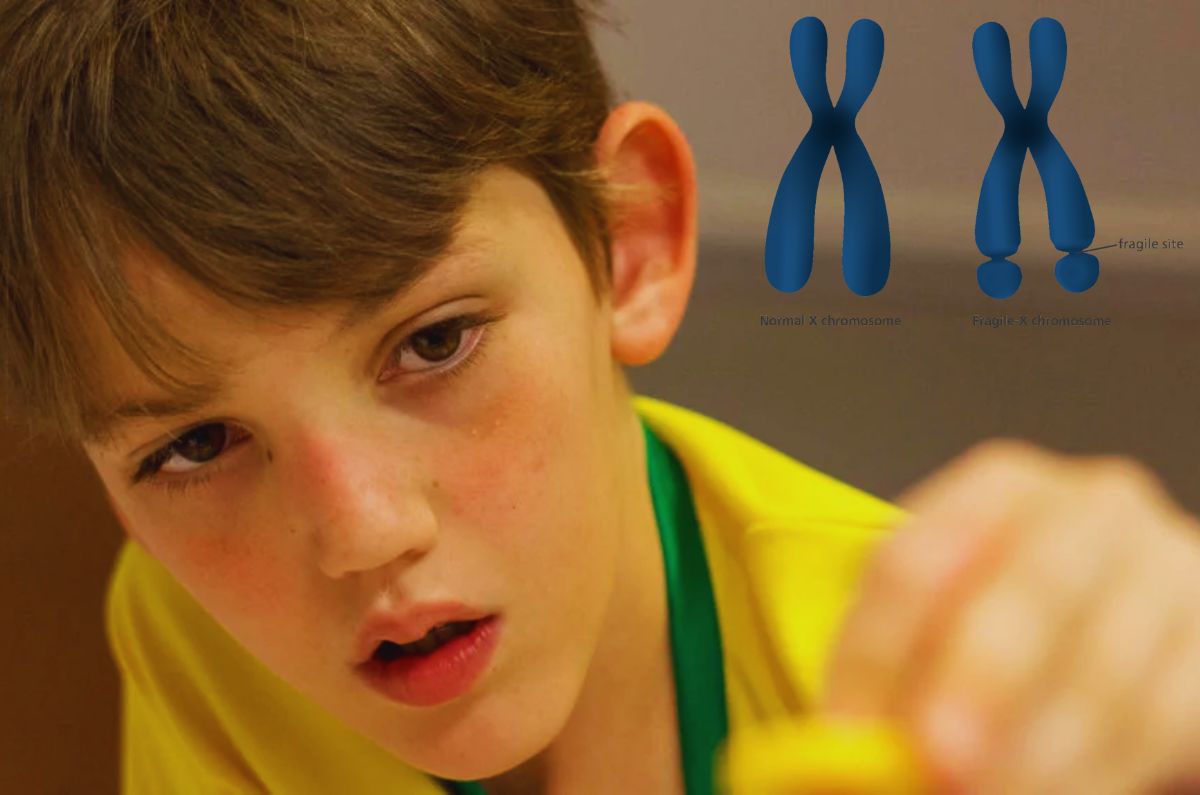 Síndrome del cromosoma X frágil: Una mutación del gen FMR1