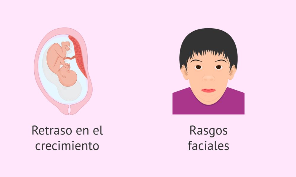 Síntomas del Síndrome alcohólico fetal