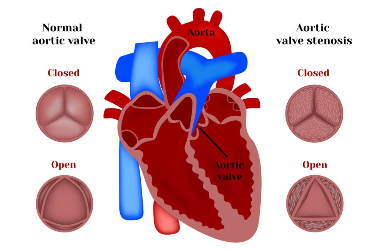 Valvulopatía: Las enfermedades de las válvulas cardiacas