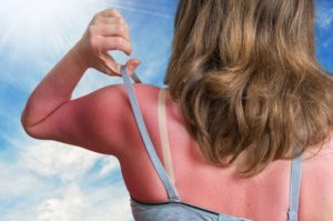 Remedios caseros para quemaduras de sol