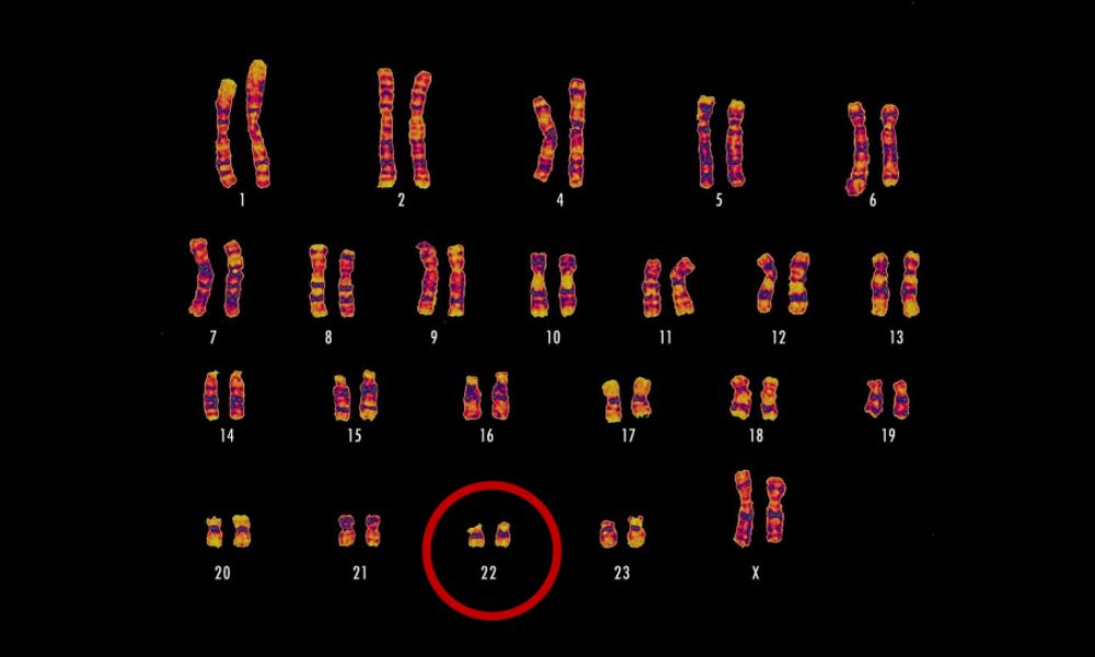 Deleción 22q11.2