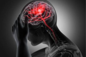 Cómo reconocer y prevenir un accidente cerebrovascular