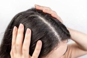 Despídete de la caspa: ¿Qué es y cómo combatirla?