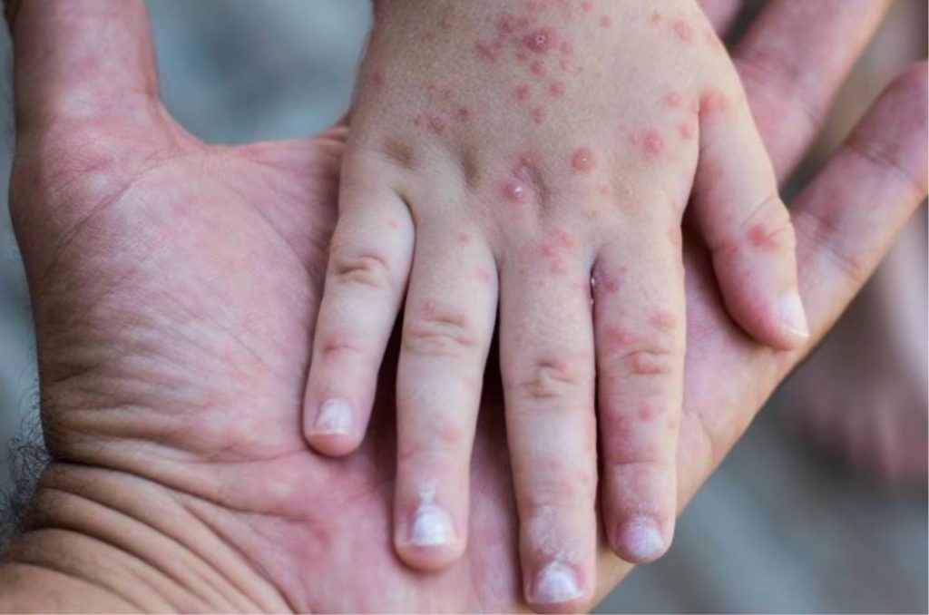 Nuevo brote de sarampion