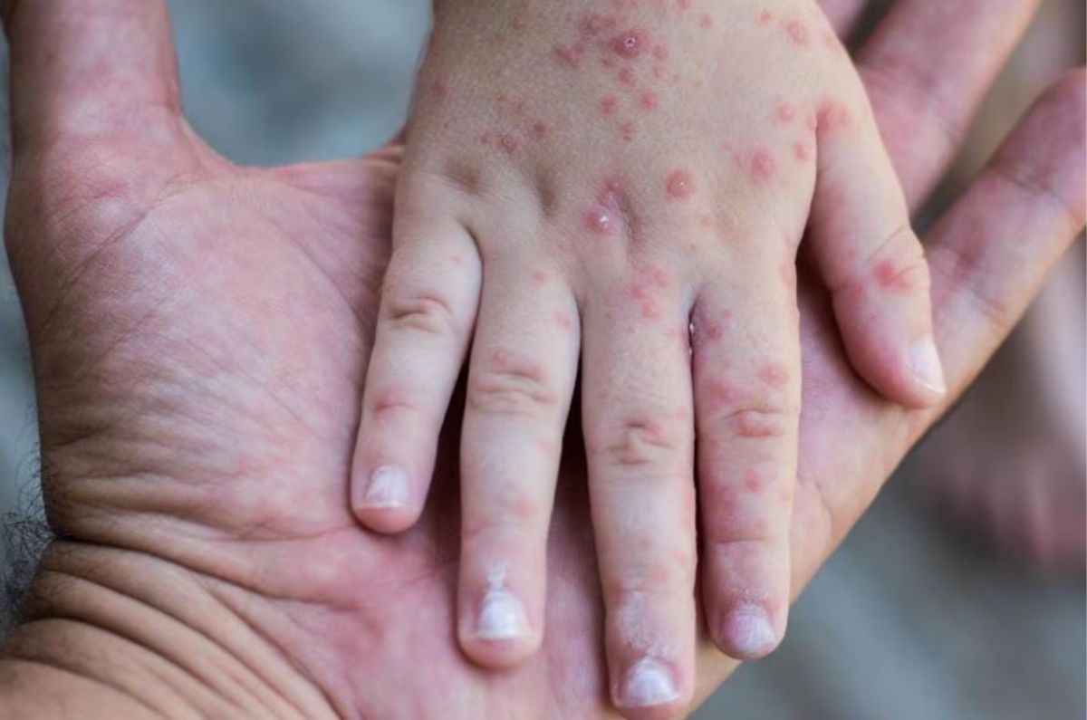 Sarampión en México: Salud confirma que hay vacunas suficientes para los próximos 2 años