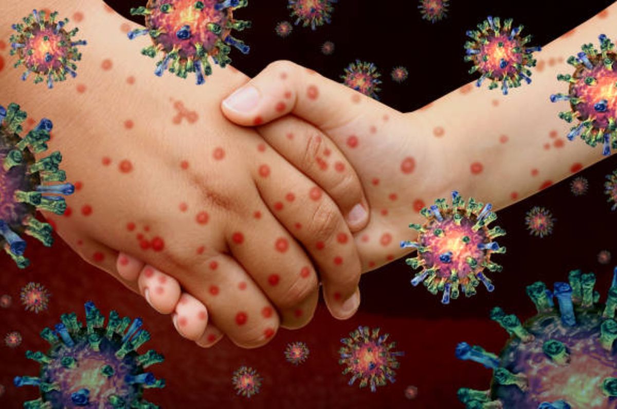 Incapacidad por sarampión en el IMSS: requisitos y cómo solicitarla