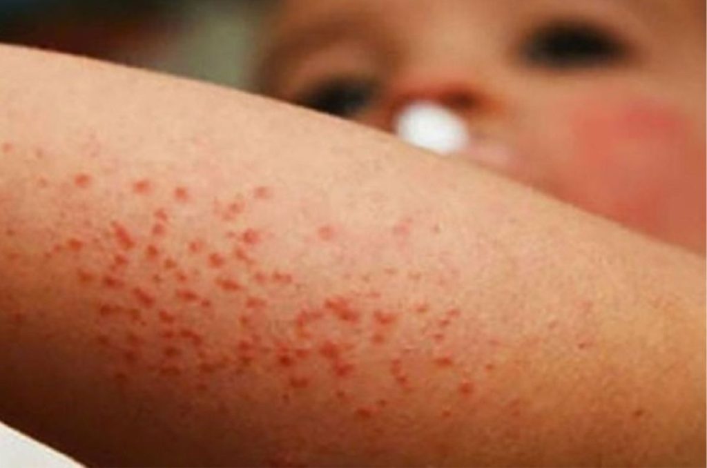 Alerta sanitaria por casos de sarampion