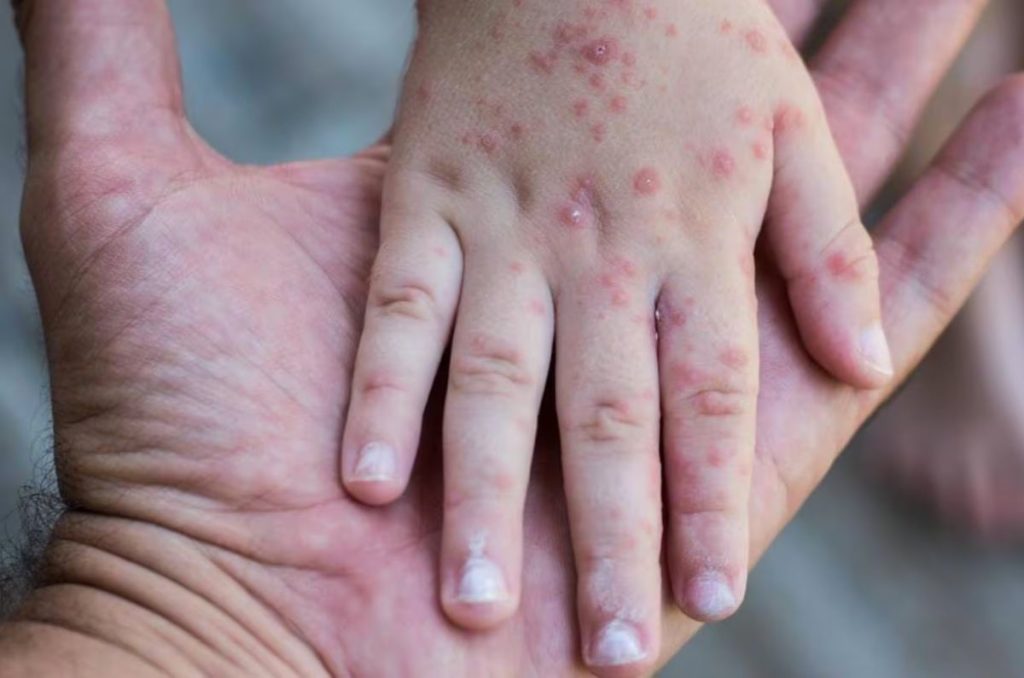 Alerta sanitaria por casos de sarampion